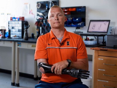 3D-печать протезов на 3D-принтере в Украине